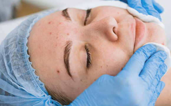 Tratamientos para tratar el acné. Doctor Gonzalo García, Dermatologo Clínico y Estético